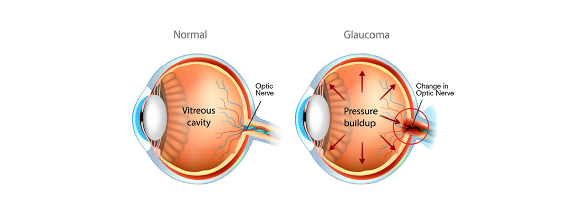 Glaucoma